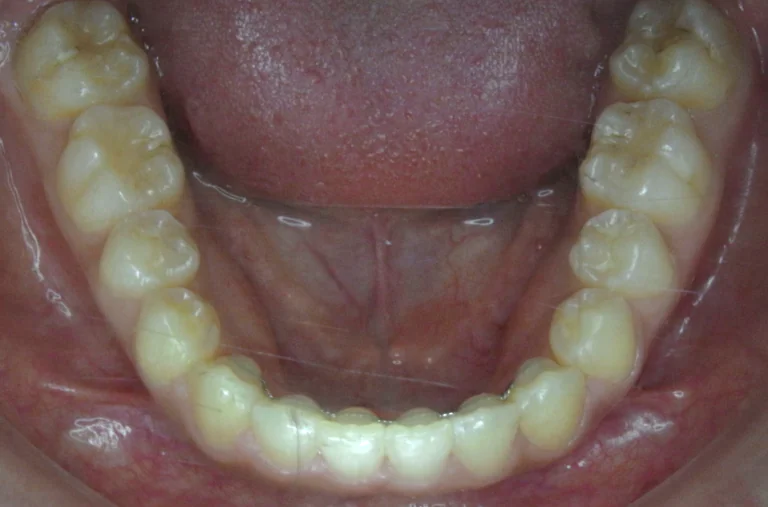 ひまわり歯科矯正歯科 全顎矯正④ after 下顎口腔内