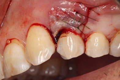 戸越なかやま歯科＋Er:YAGレーザーを併用した歯周組織再生療法＋手術中