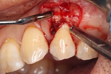 戸越なかやま歯科＋Er:YAGレーザーを併用した歯周組織再生療法＋手術中