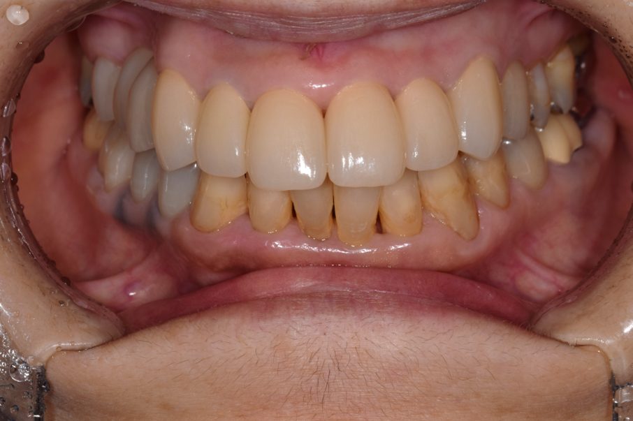 横浜日吉おおとう歯科-インプラント　セラミッククラウン①-after-正面