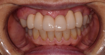 横浜日吉おおとう歯科-インプラント　セラミッククラウン②-after-正面