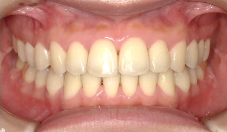 ひまわり歯科矯正歯科 全顎矯正⑤ after 正面