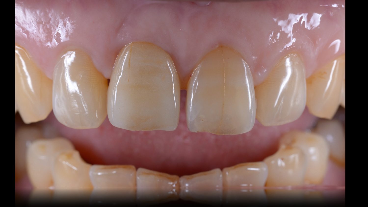 おぎの歯科医院 インプラント治療① after