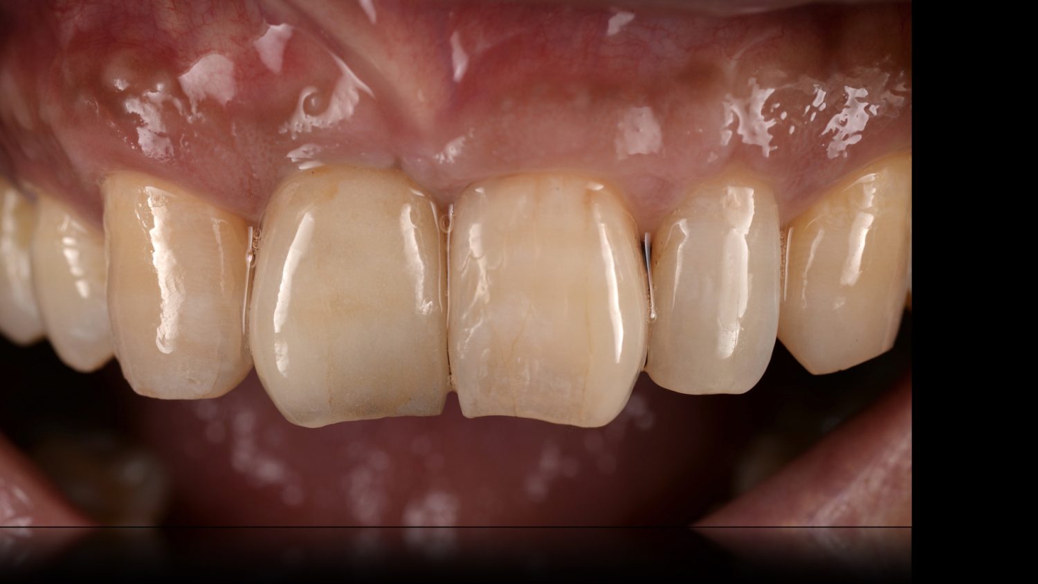 おぎの歯科医院 インプラント治療② after