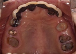 横浜日吉おおとう歯科-インプラント　セラミッククラウン②-before-上