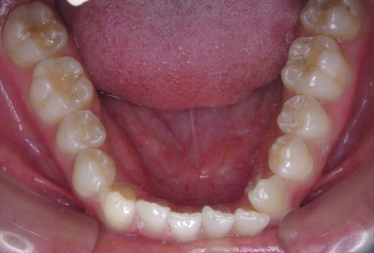 ひまわり歯科矯正歯科 全顎矯正④ before 下顎口腔内