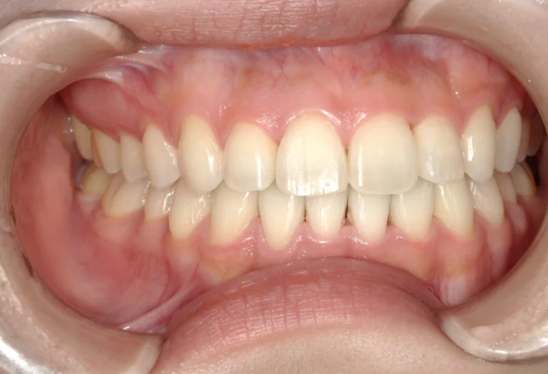 ひまわり歯科矯正歯科 全顎矯正⑥ after 右側面