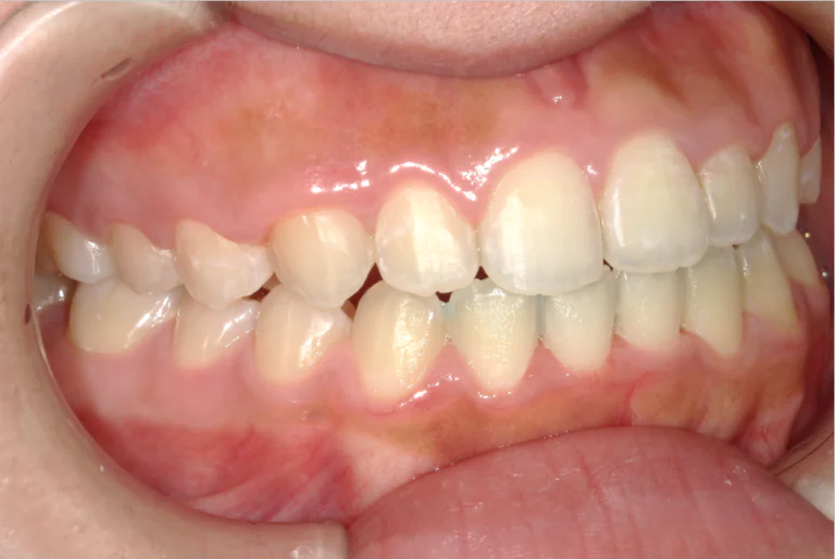 ひまわり歯科矯正歯科 部分矯正③ after 右側面