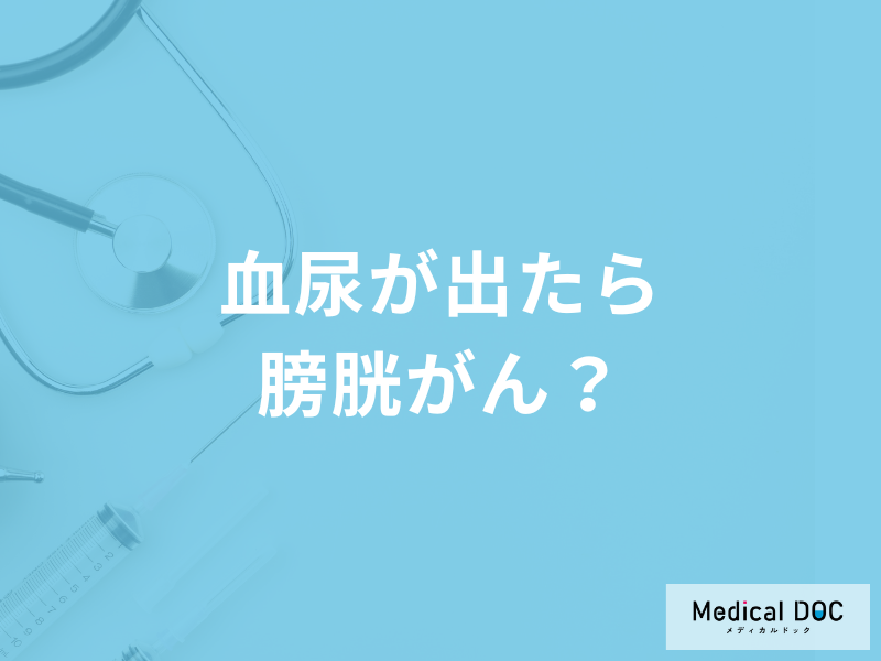 「どんな血尿が出たら膀胱がん」を疑った方が良い？検査法についても医師が徹底解説！