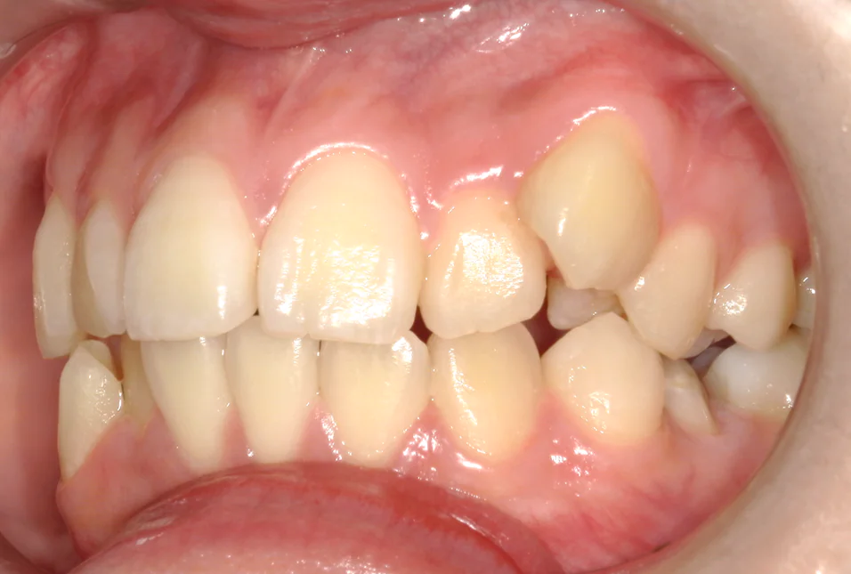 ひまわり歯科矯正歯科 部分矯正① before 左側面