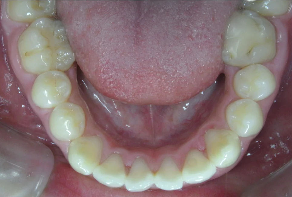 ひまわり歯科矯正歯科 部分矯正④ before 下顎口腔内