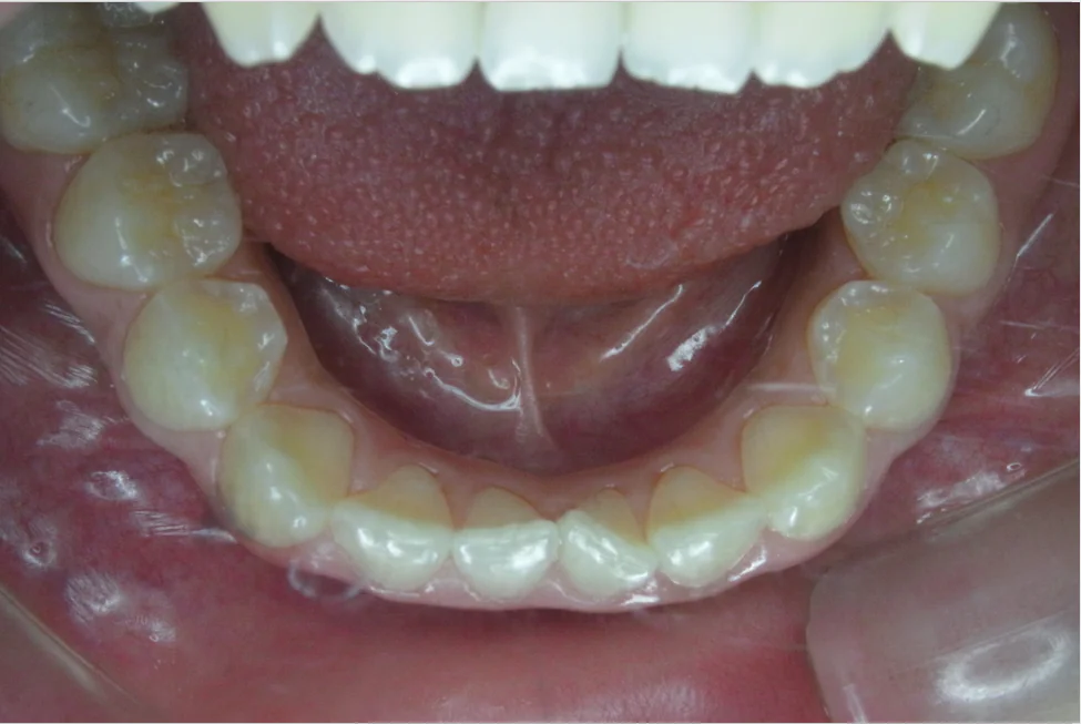 ひまわり歯科矯正歯科 部分矯正③ before 下顎口腔内