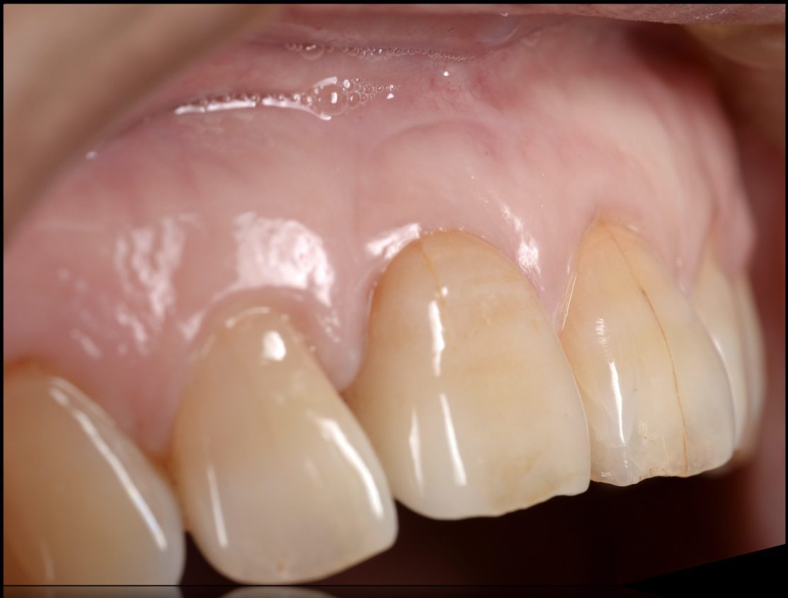 おぎの歯科医院 インプラント治療① after