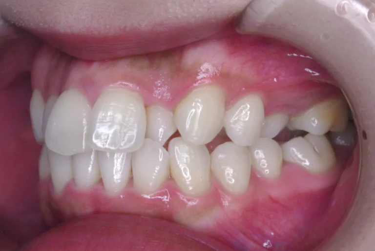 ひまわり歯科矯正歯科 全顎矯正⑥ before 左側面