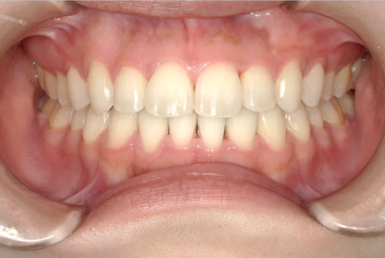 ひまわり歯科矯正歯科 全顎矯正⑥ after 正面