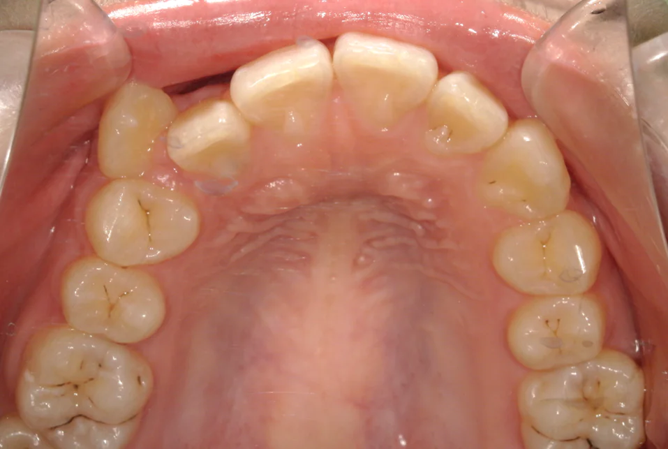 ひまわり歯科矯正歯科 部分矯正① before 上顎口腔内