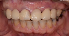 横浜日吉おおとう歯科-インプラント　セラミッククラウン②-before-正面