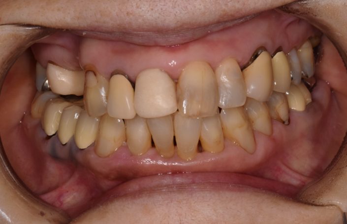 横浜日吉おおとう歯科-インプラント　セラミッククラウン①-before-正面