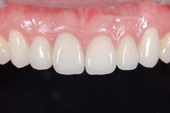 戸越なかやま歯科＋歯周病患者に対して前歯部に審美修復を行ったケース＋セラミックセット後3年