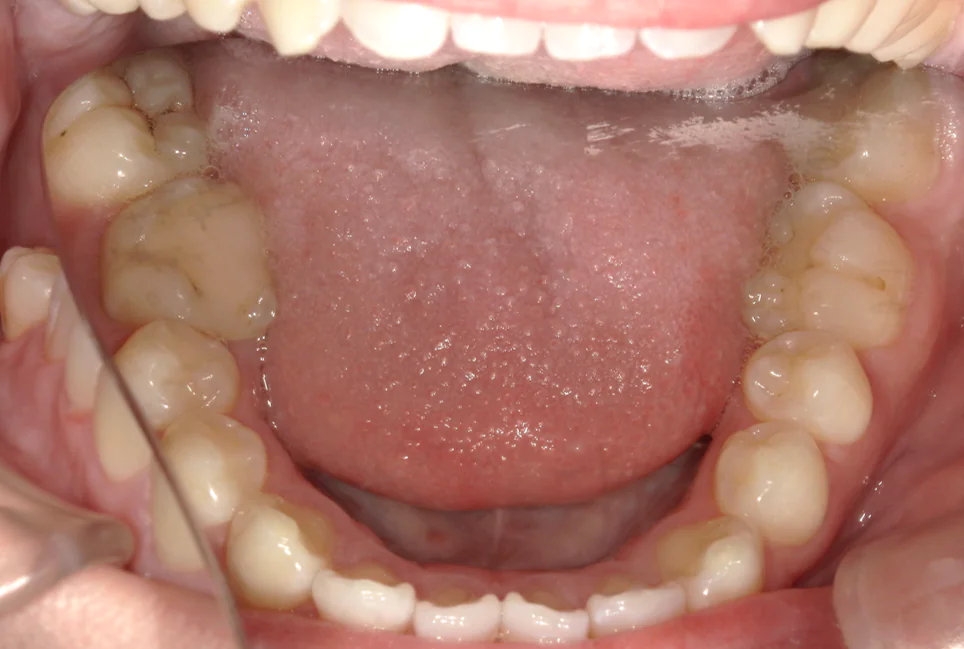 ひまわり歯科矯正歯科 部分矯正④ after 下顎口腔内
