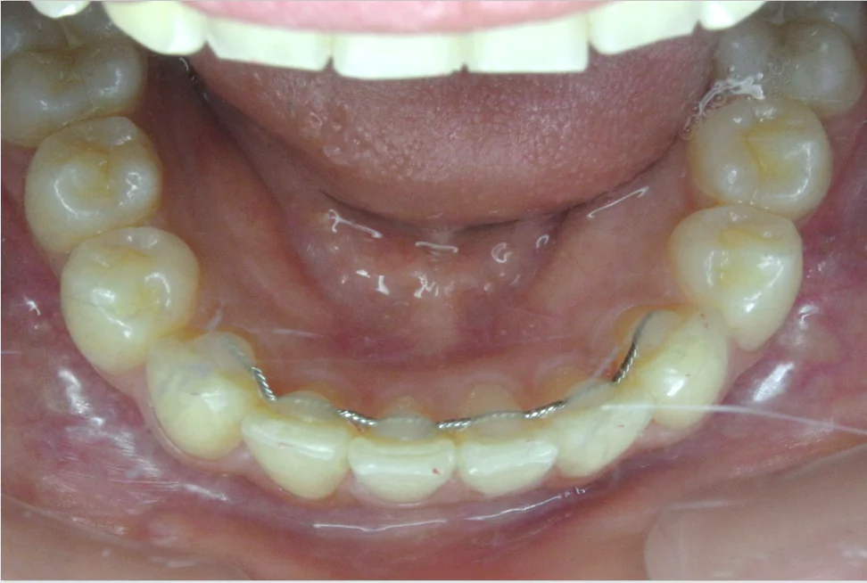 ひまわり歯科矯正歯科 全顎矯正② after 下顎口腔内