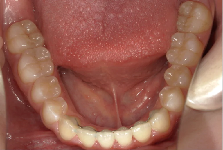 ひまわり歯科矯正歯科 部分矯正③ after 下顎口腔内