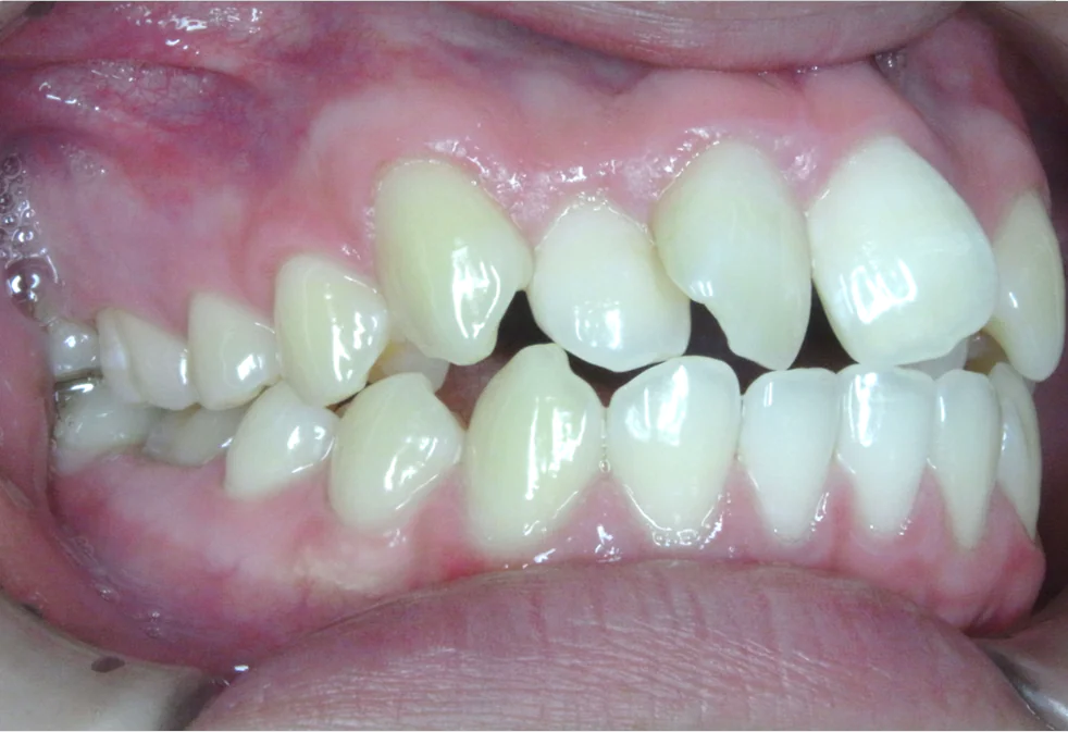 ひまわり歯科矯正歯科 部分矯正④ before 右側面