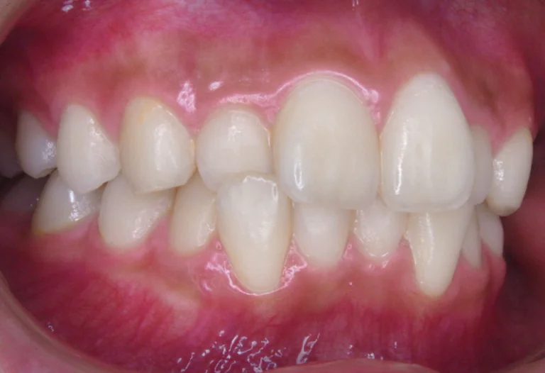 ひまわり歯科矯正歯科 全顎矯正② before 右側面