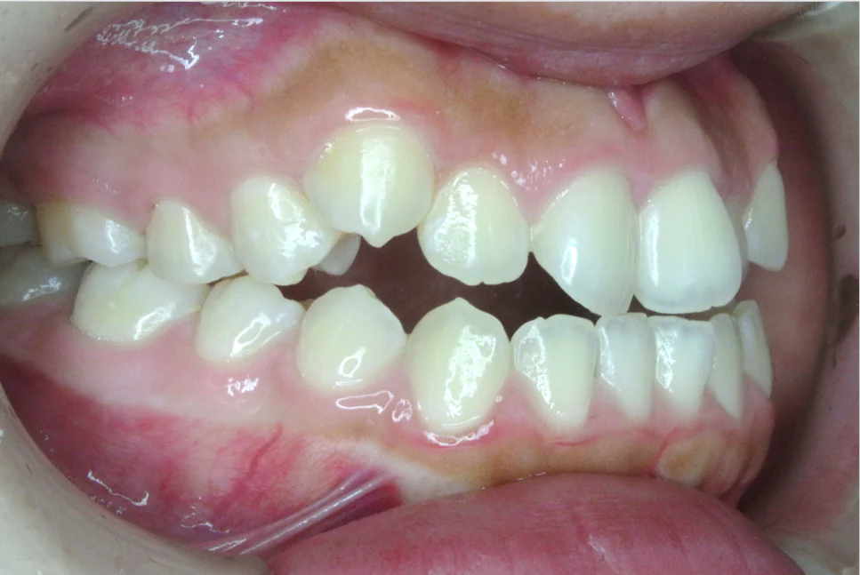 ひまわり歯科矯正歯科 部分矯正③ before 右側面