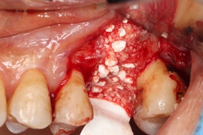 戸越なかやま歯科＋歯根破折した歯に対してRidge Preservationを行いインプラント埋入を行ったケースの症例＋before