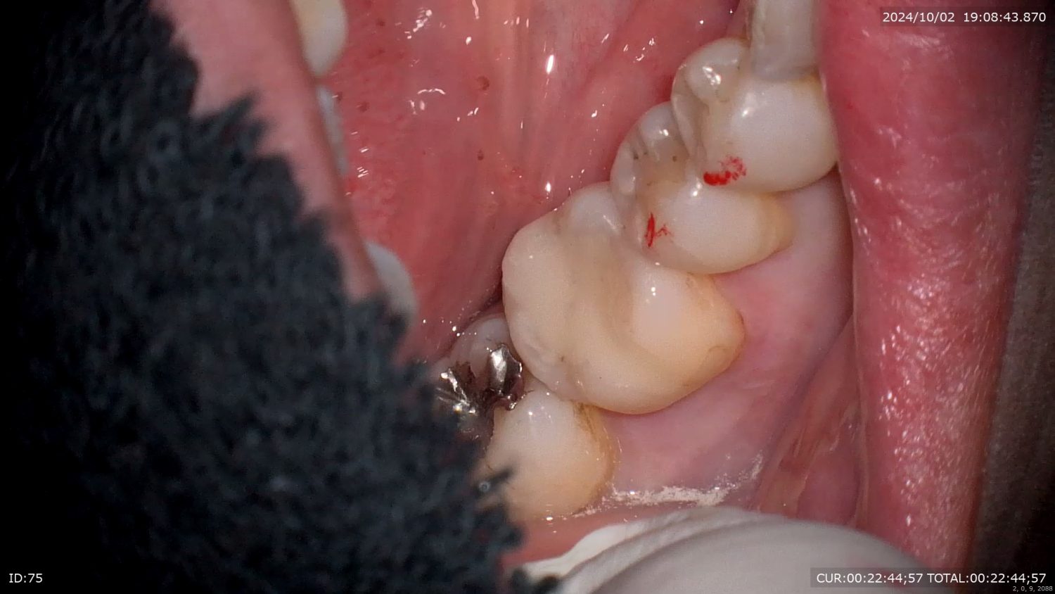 西新宿五丁目デンタルクリニック歯の移植after