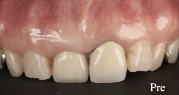 小貫歯科医院 両側上顎中切歯２本のセラミック治療 before