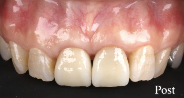小貫歯科医院 両側上顎中切歯２本のセラミック治療 after