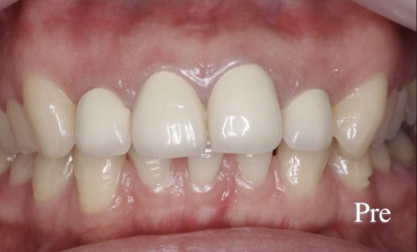 小貫歯科医院 両側上顎中切歯、側切歯４本のセラミック治療 before