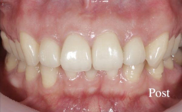 小貫歯科医院 両側上顎中切歯、側切歯４本のセラミック治療 after