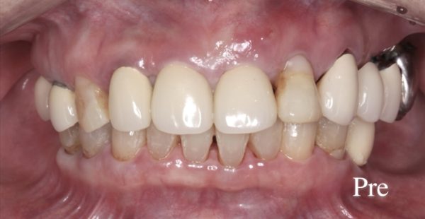 小貫歯科医院 セラミック治療およびインプラント治療と上部構造 正面before