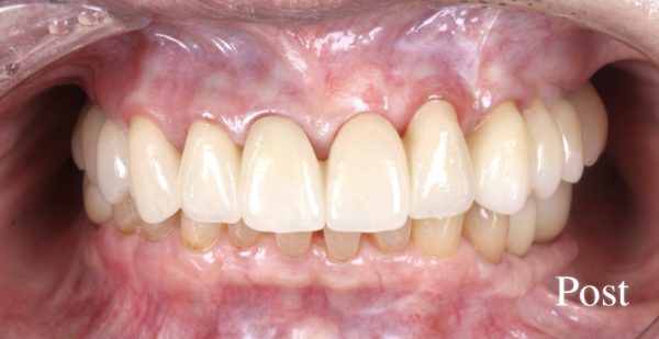 小貫歯科医院 セラミック治療およびインプラント治療と上部構造 正面after
