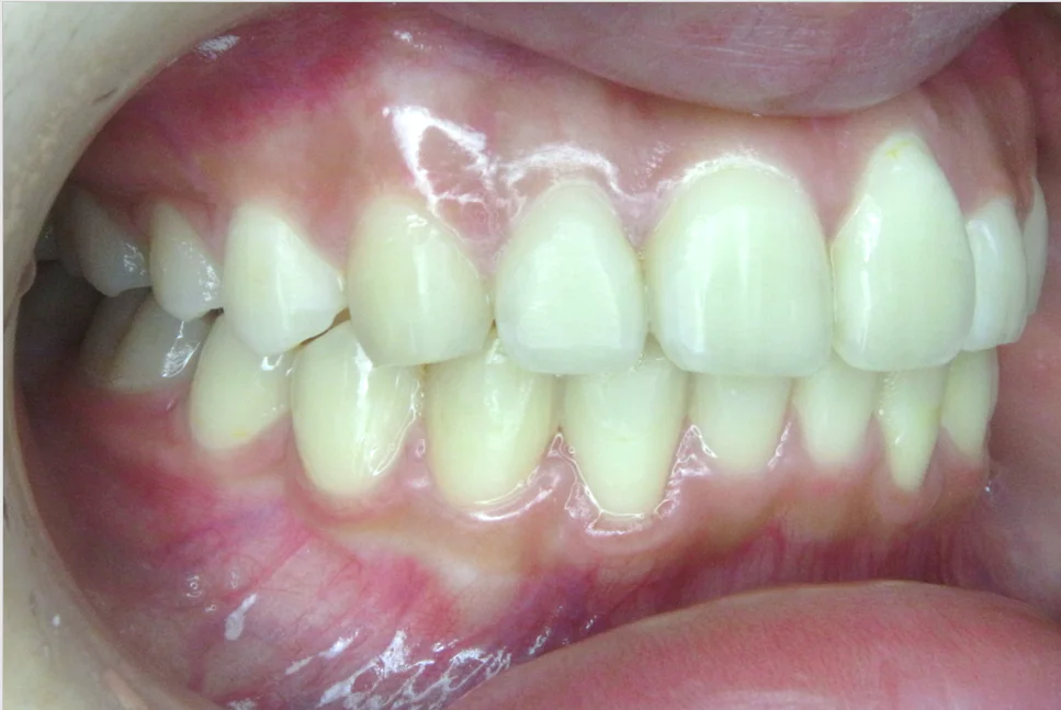 ひまわり歯科矯正歯科 全顎矯正② after 右側面