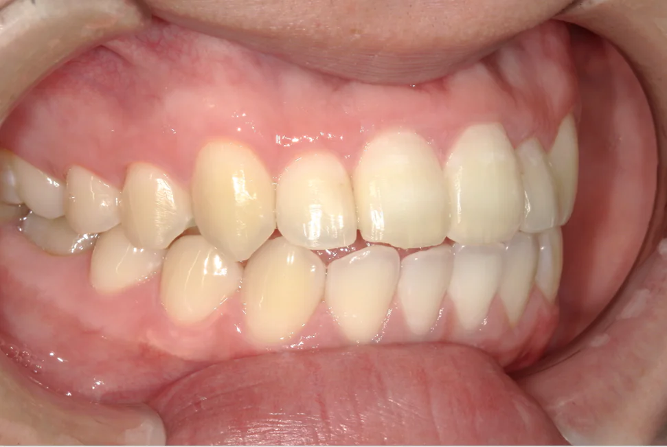 ひまわり歯科矯正歯科 部分矯正④ after 右側面