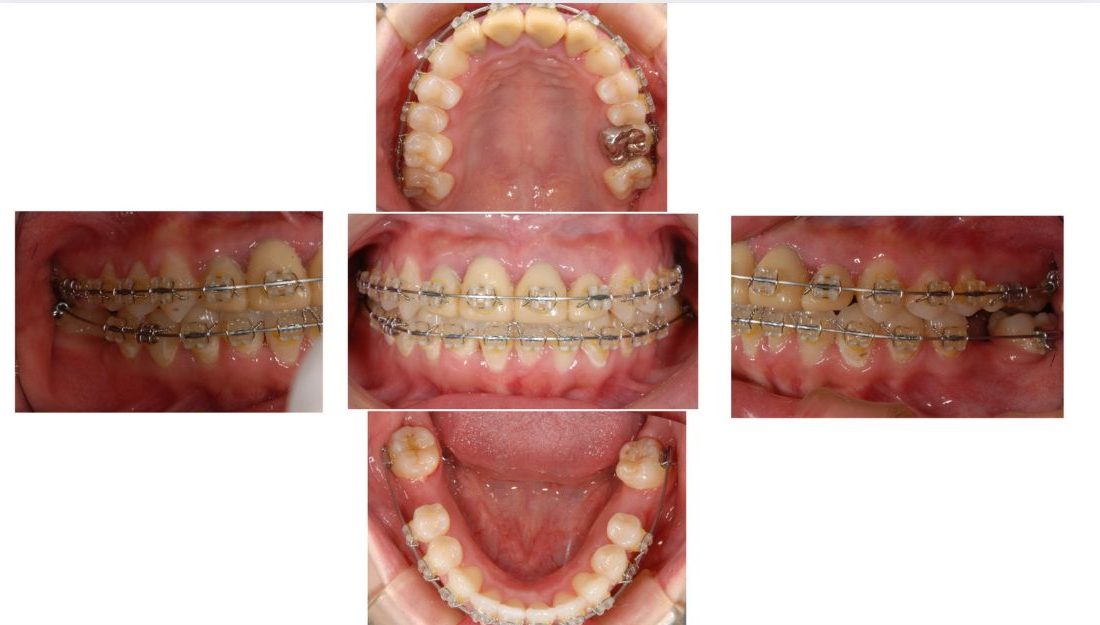おぎの歯科医院 根管治療・矯正治療・補綴治療 治療中
