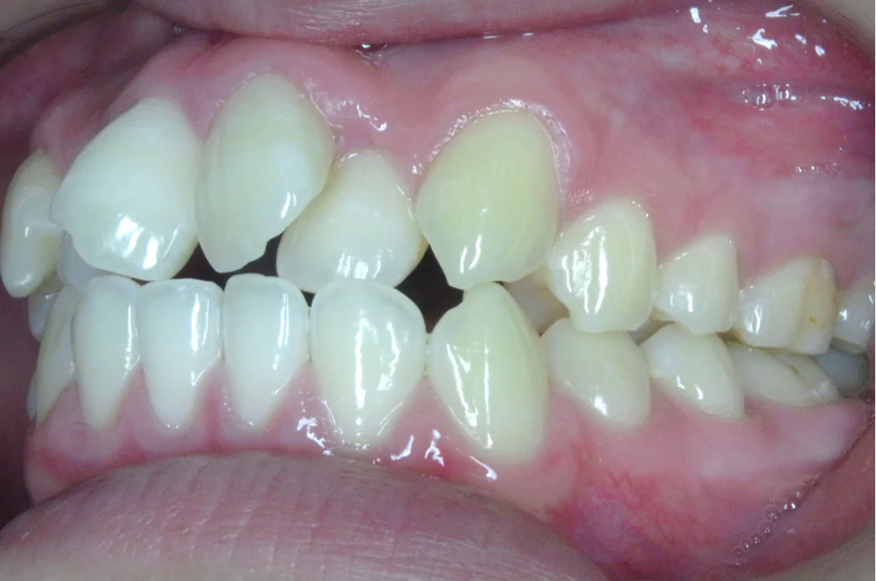 ひまわり歯科矯正歯科 部分矯正④ before 左側面