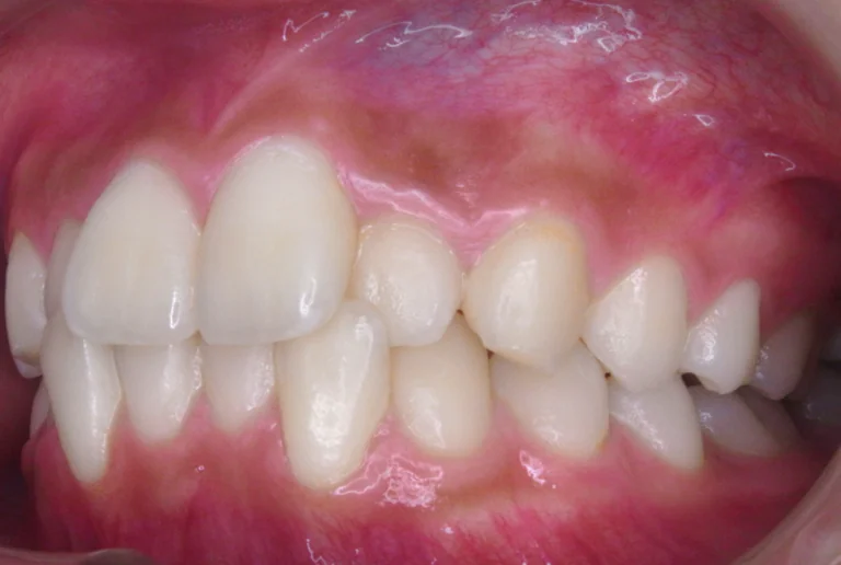 ひまわり歯科矯正歯科 全顎矯正② before 左側面