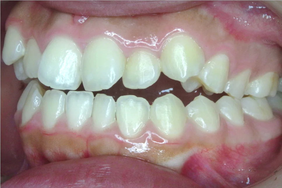 ひまわり歯科矯正歯科 部分矯正③ before 左側面