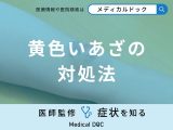非公開: 「黄色いあざ」の対処法はご存知ですか？医師が解説！