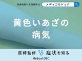 非公開: 「黄色いあざ」で考えられる病気はご存知ですか？医師が解説！
