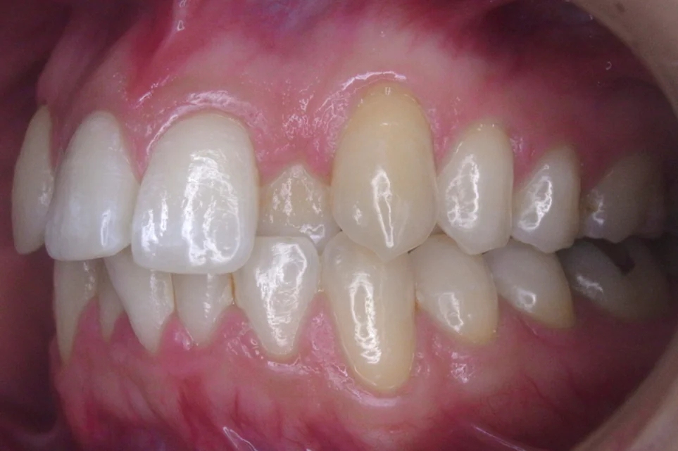 ひまわり歯科矯正歯科 部分矯正⑤ before 左側面