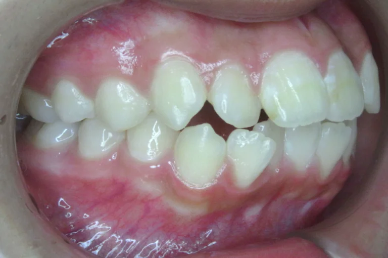 ひまわり歯科矯正歯科 全顎矯正③ before 右側面