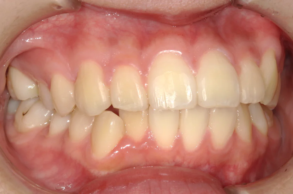 ひまわり歯科矯正歯科 部分矯正① after 右側面