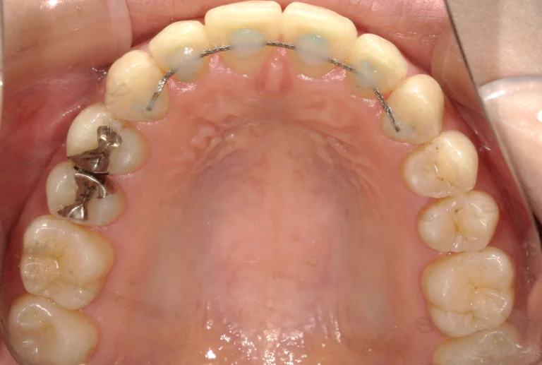 ひまわり歯科矯正歯科 全顎矯正⑤ after 上顎口腔内