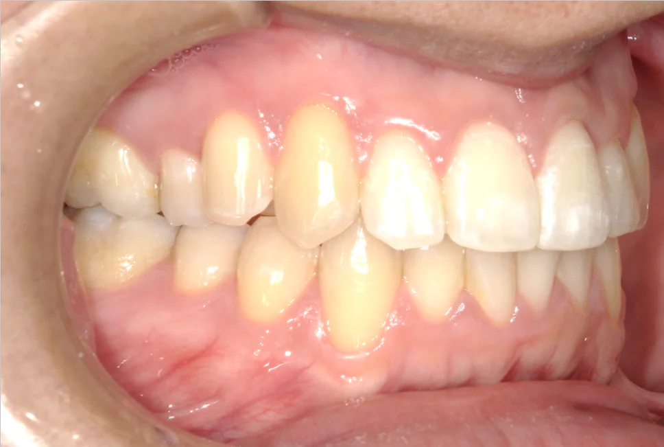 ひまわり歯科矯正歯科 部分矯正⑤ after 右側面